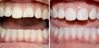 Эстетическая реставрация зубов до и после в стоматологии Медведково (сеть Родня)