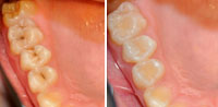 Лечение поверхностного кариеса до и после в стоматологии в Люберцах (сеть Родня)