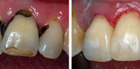 Пришеечный кариес у основания зуба до и после в стоматологии Медведково (сеть Родня)