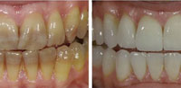 Виниры на передние зубы до и после в стоматологии Медведково (сеть Родня)