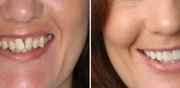 Исправление прикуса до и после в стоматологии в Люберцах (сеть Родня)