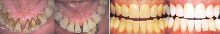 Отложения на зубах до и после чистки