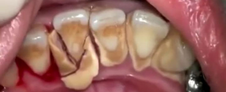 Зубной камень на передних зубах