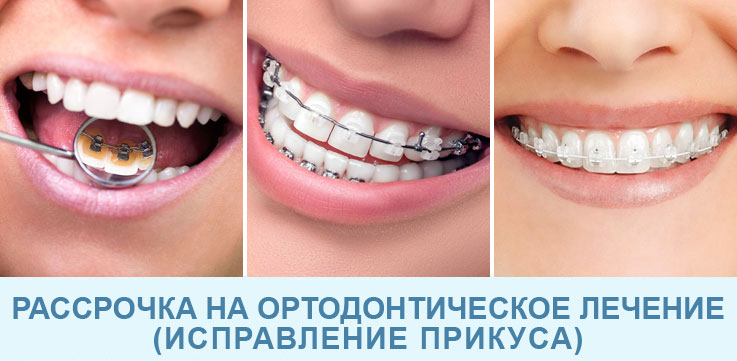 Рассрочка на ортодонтическое лечение (исправление прикуса)